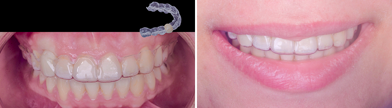 bridge cantilever zircone, 1ère séance