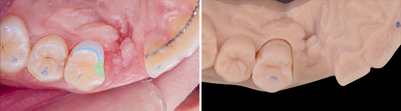 bridge cantilever zircone, 2ème séance