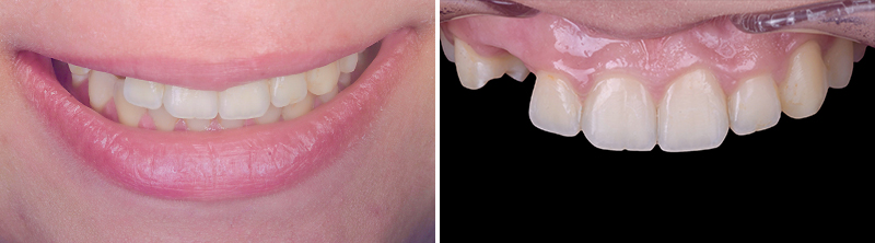 bridge cantilever zircone, situation initiale