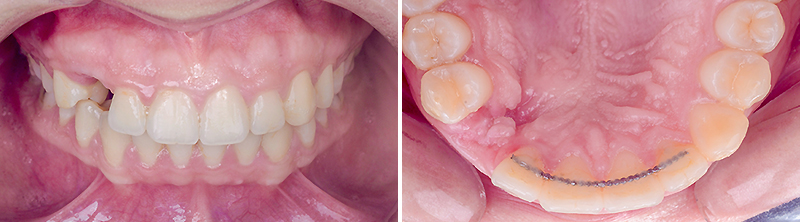 bridge cantilever zircone, situation initiale