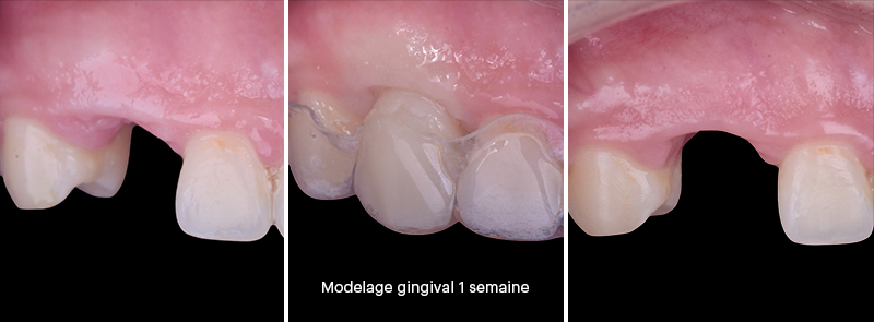 bridge cantilever zircone, 1ère séance