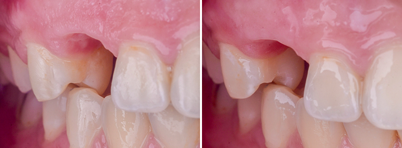 bridge cantilever zircone, 2ème séance