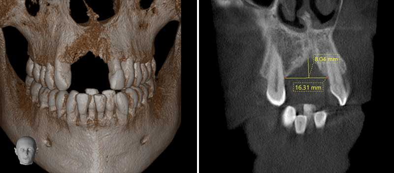 Reconstruction 3D et coupe coronale du cone beam passant par le défaut antérieur 3 mois après les avulsions de 12, 21 et ablation de l’implant en site 11 montrant la sévérité du défaut vertical