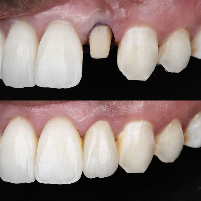 fluorose, Réalisation d’une couronne en zircone stratifiée sur 22