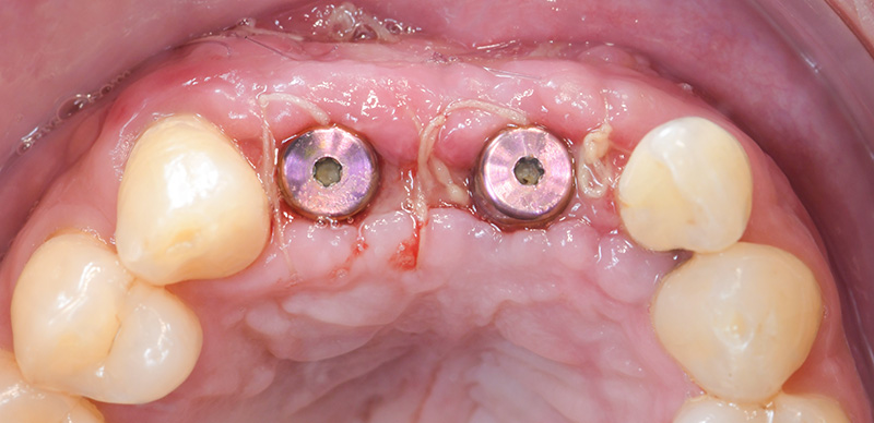 Vue clinique occlusale à 15 jours post-opératoire après approfondissement 