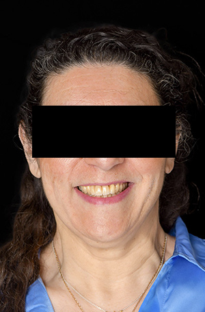 Portrait de la patiente avec le provisoire en place