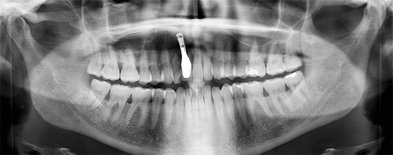 Prise en charge, radiographie panoramique initale
