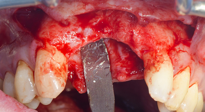 Mise en évidence du défaut vertical et transversal après élévation du lambeau en épaisseur totale