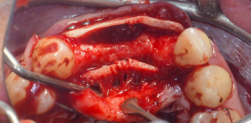 Mise en place des lames corticales en vestibulaire et palatin