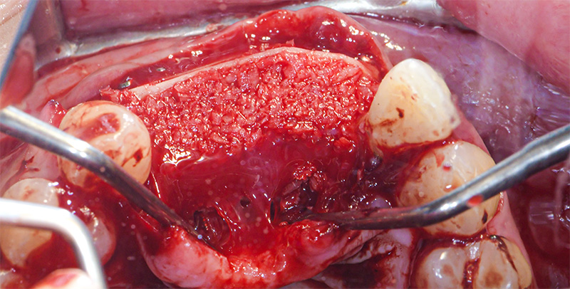 Mise en place des lames corticales en vestibulaire et palatin 