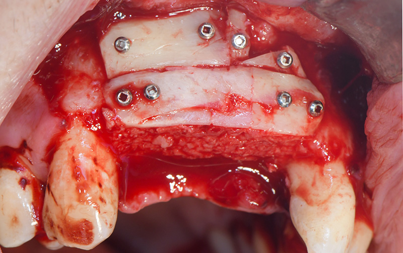 Mise en place des lames corticales en vestibulaire et palatin