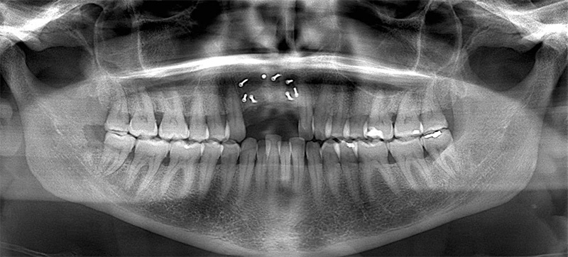 Radiographie panoramique post-opératoire
