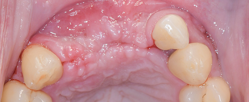 Cicatrisation des tissus mous à 4 mois post-opératoire