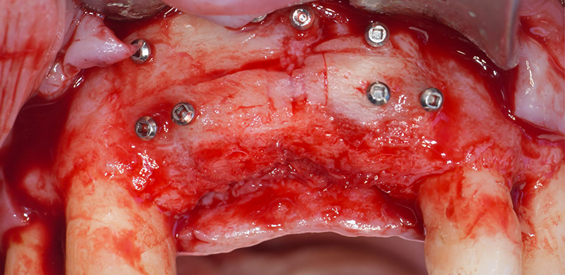 l’aspect de la reconstruction osseuse est très satisfaisante