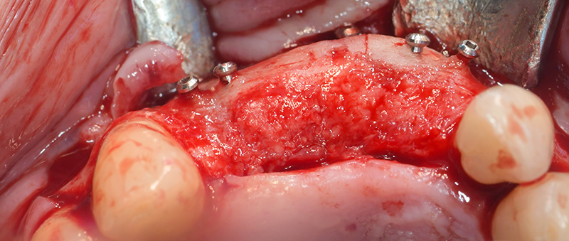 l’aspect de la reconstruction osseuse est très satisfaisante