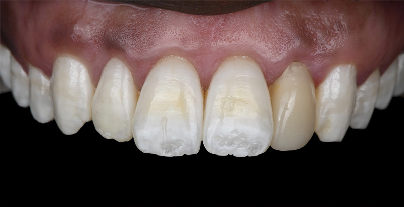 Situation fin du traitement éclaircissement externe