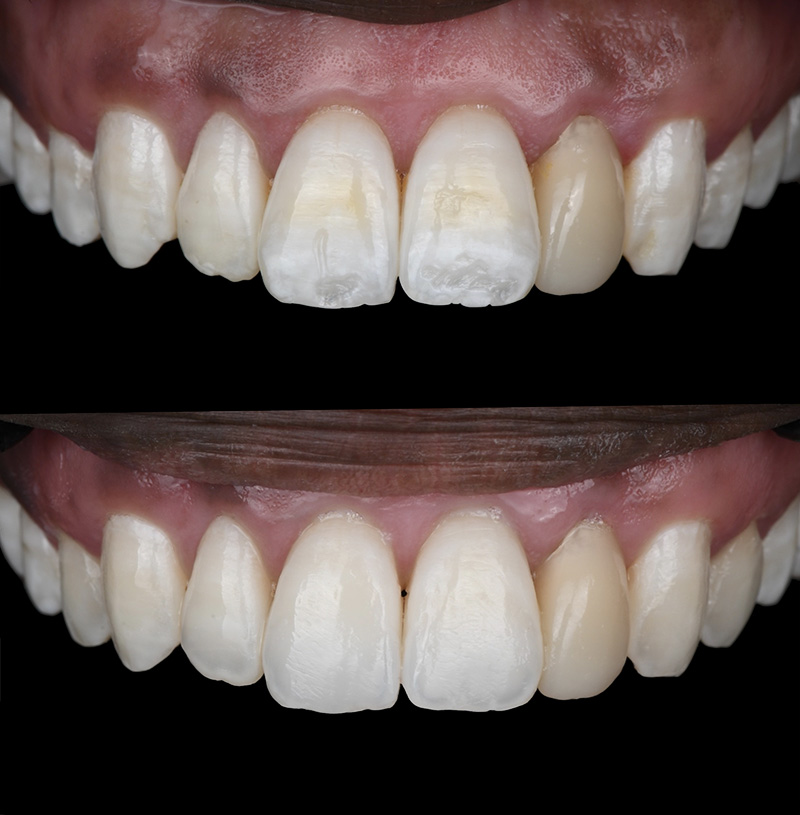 fluorose, Résultat intermédiaire après érosion infiltration