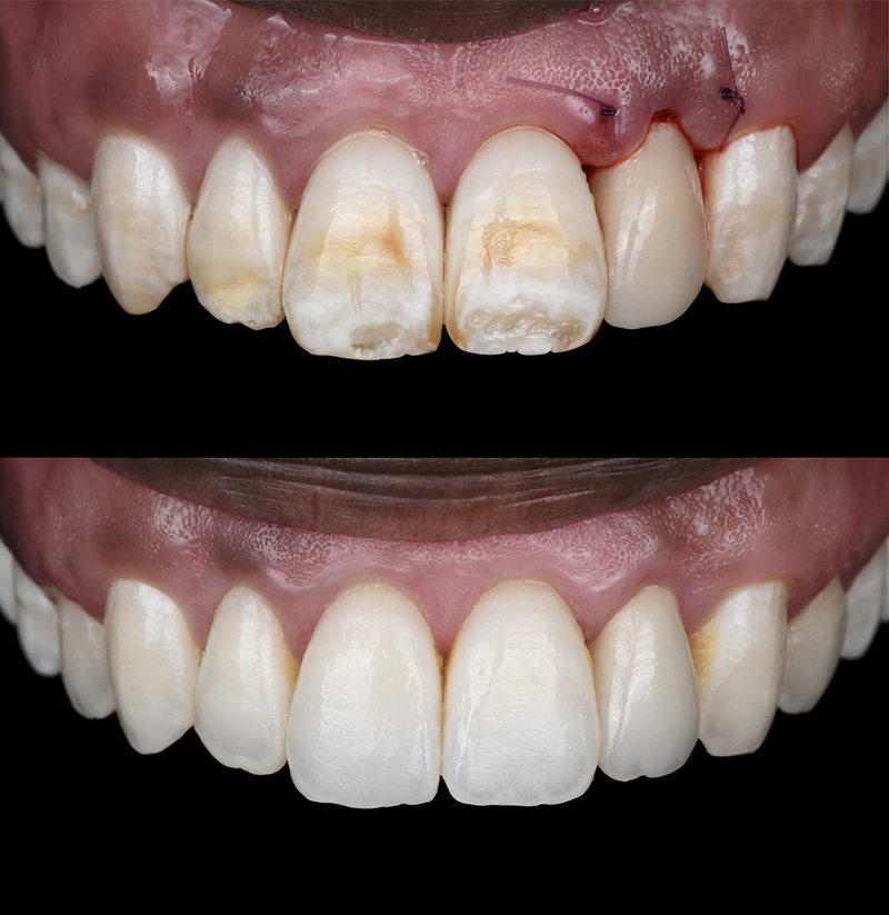 Résultat avant et après