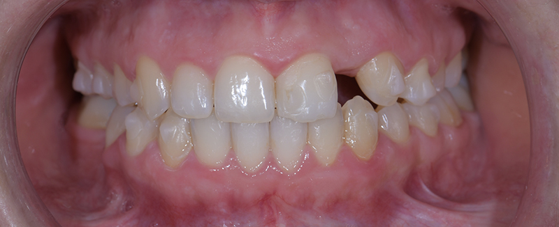 Ralph Boutros - Situation après traitement orthodontique