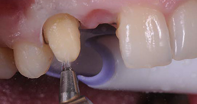 la dent-pilier a été nettoyée par abrasion à air avec le RONDOflex 360