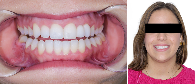 Traitement prothétique