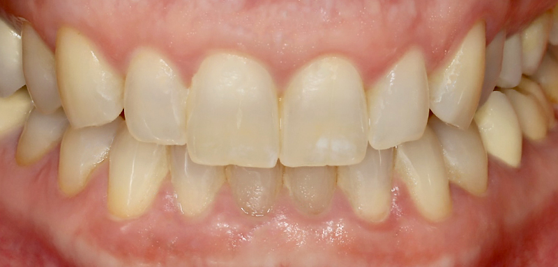 Contourner greffe osseuse, situation clinique