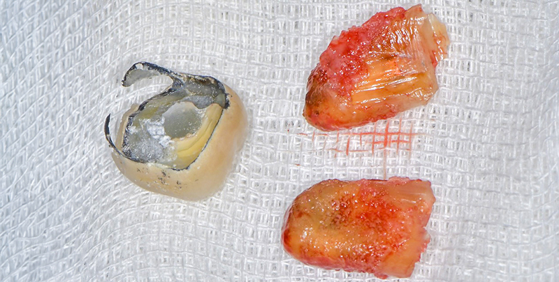 Contourner greffe osseuse, extraction atraumatique de la 36