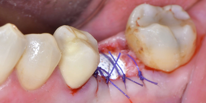 Contourner greffe osseuse, préservation alvéolaire