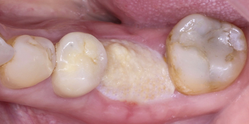 Contourner greffe osseuse 36, contrôle à 6 semaines post extraction