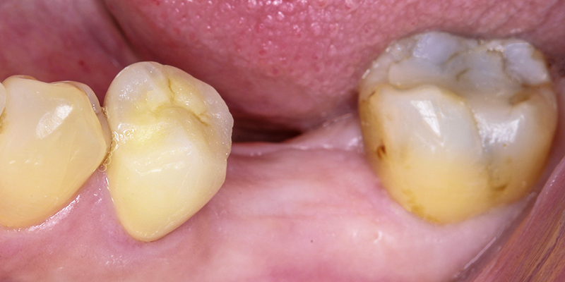 contourner greffe osseuse