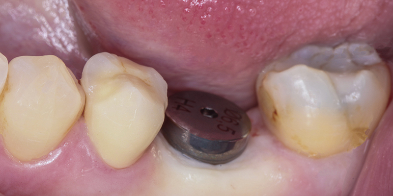 contourner greffe osseuse