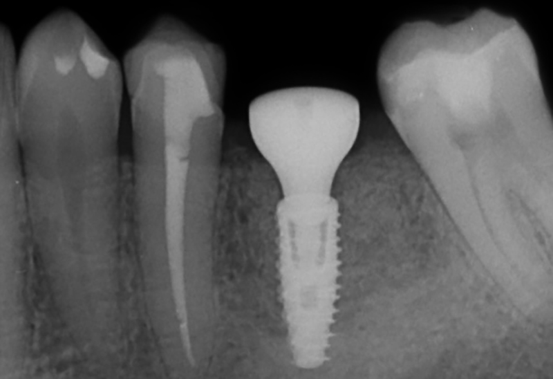 contourner greffe osseuse, pose de l’implant 36