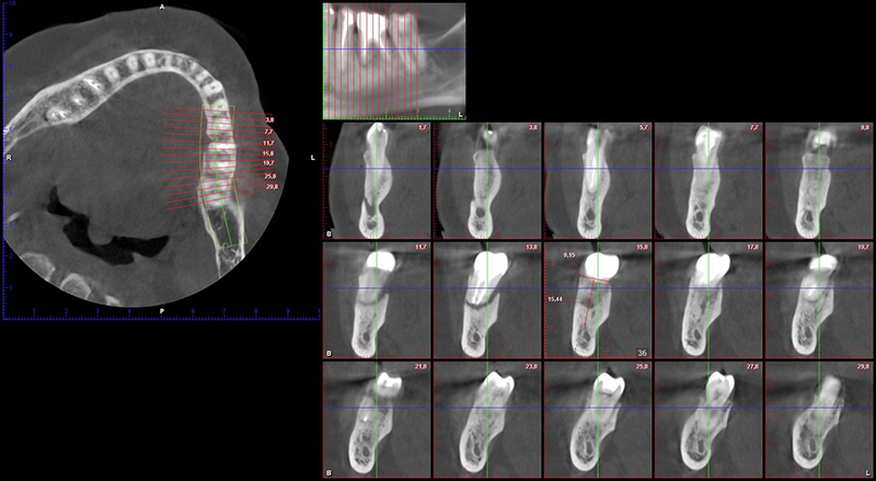Contourner greffe osseuse