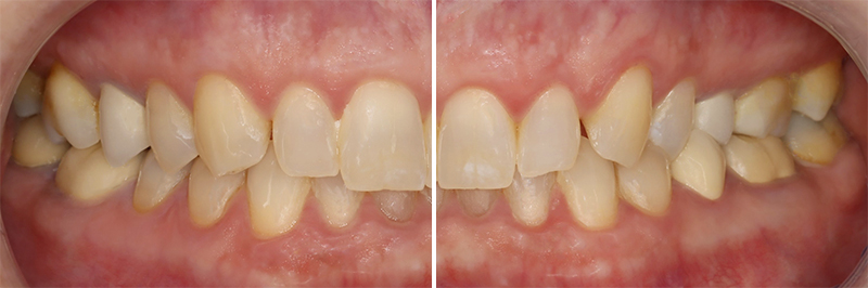 Contourner greffe osseuse, situation clinique