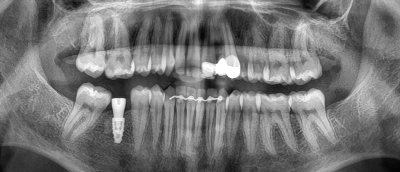 Traitement prothétique radio finale