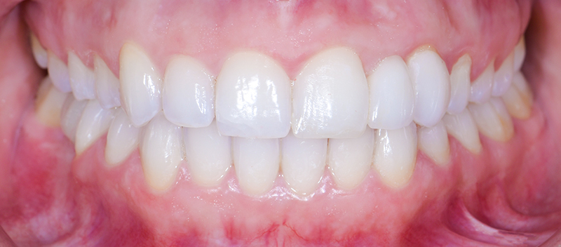 Traitement prothétique