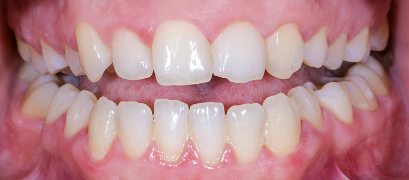 Traitement prothétique