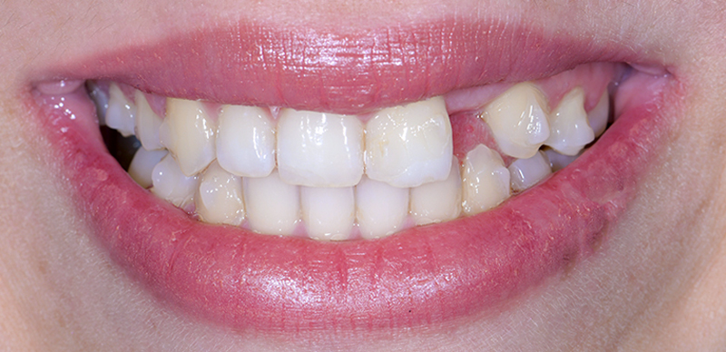 Traitement prothétique