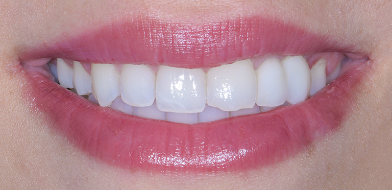 Traitement prothétique