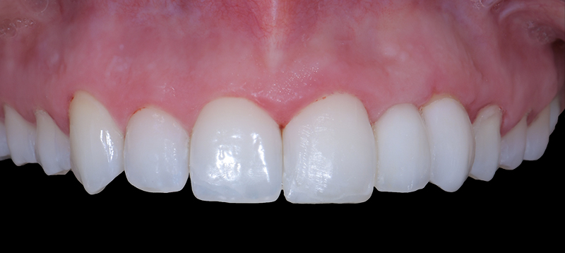 stratification de la 21