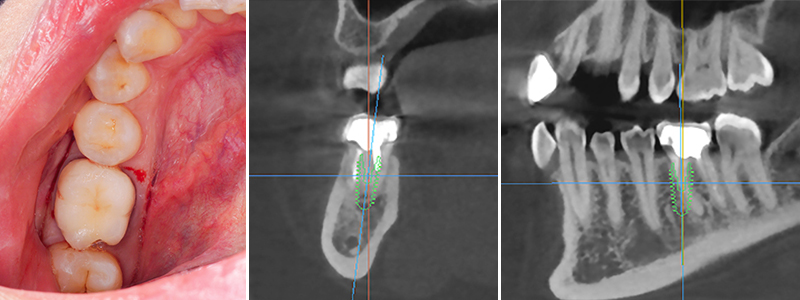 extraction implantaire