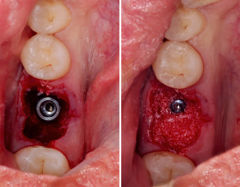 extraction implantaire