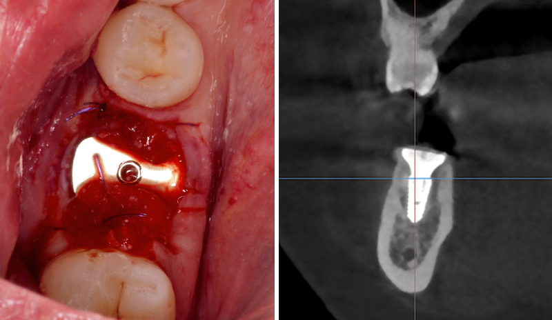 extraction implantaire, vis de cicatrisation anatomique 