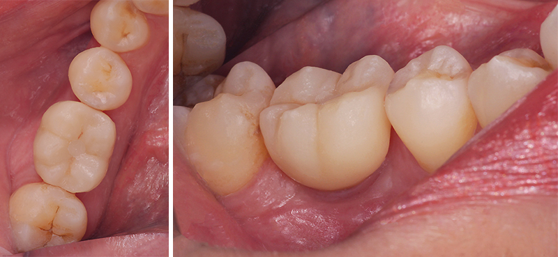 extraction implantaire, couronne en place