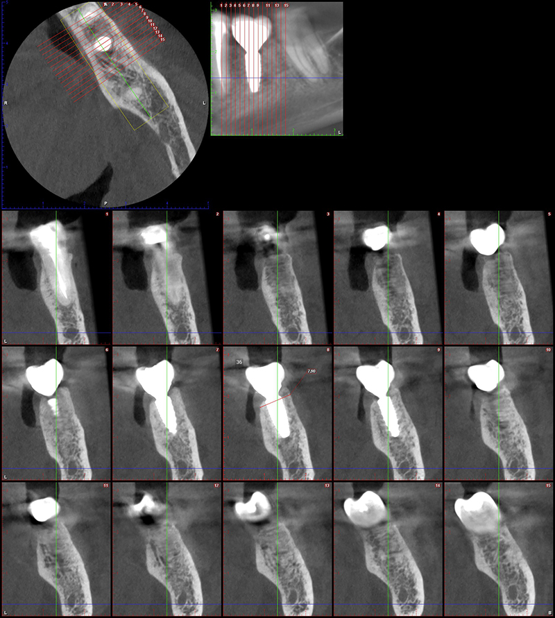 Contourner greffe osseuse