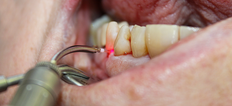 laser ErYAG patiente