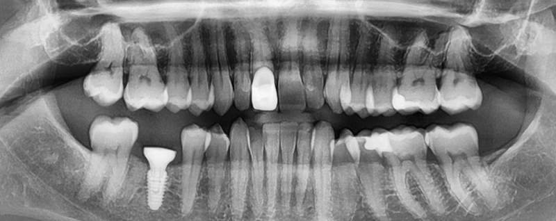 radio post-opératoire