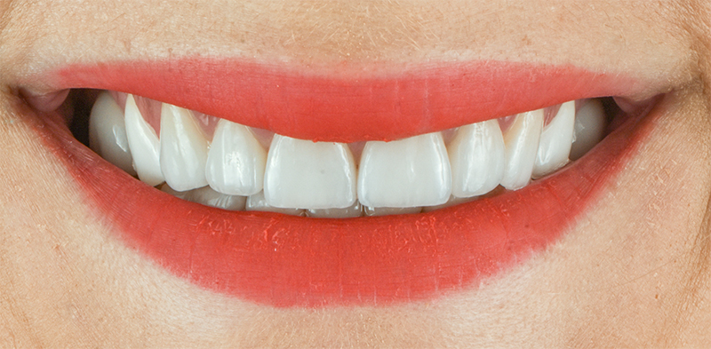 Réhabilitation esthétique, situation finale du sourire