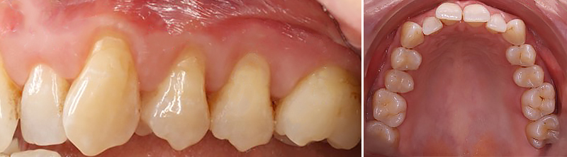 L’hygiène orale après une chirurgie muco-gingivale