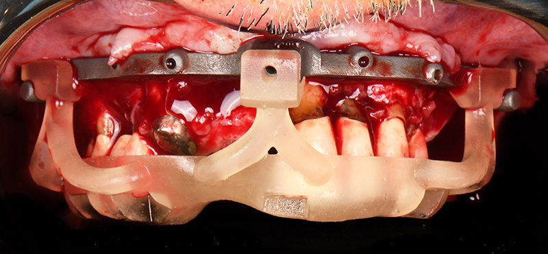 implantologie guidée : Le guide de base ou ceinture de stabilisation est positionné dans un premier temps au maxillaire.